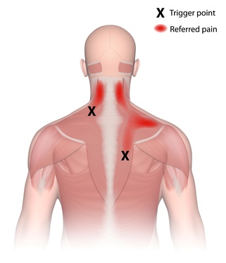 Trigger points